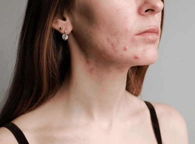Žena s cystickou akné na obličeji a krku.