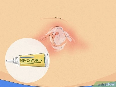 Mazání pupíku antibiotickou mastí Neosporin.