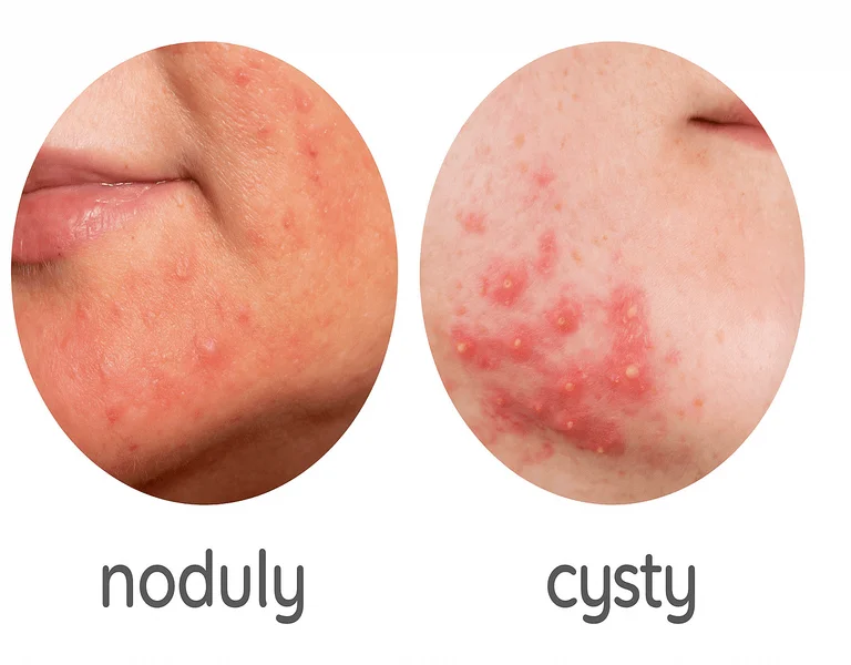 Porovnání uzlové a cystické akné na lidské kůži.