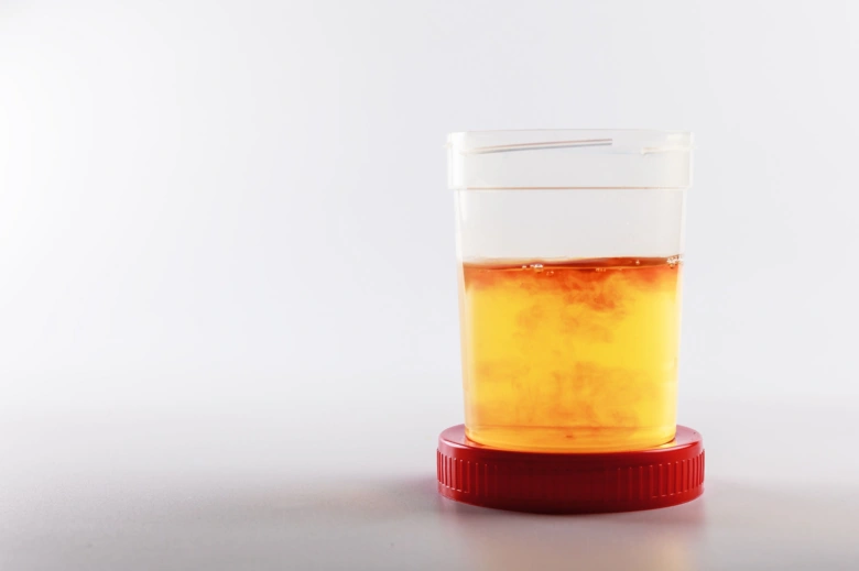 Urine sample in container for kidney attack first aid article.
